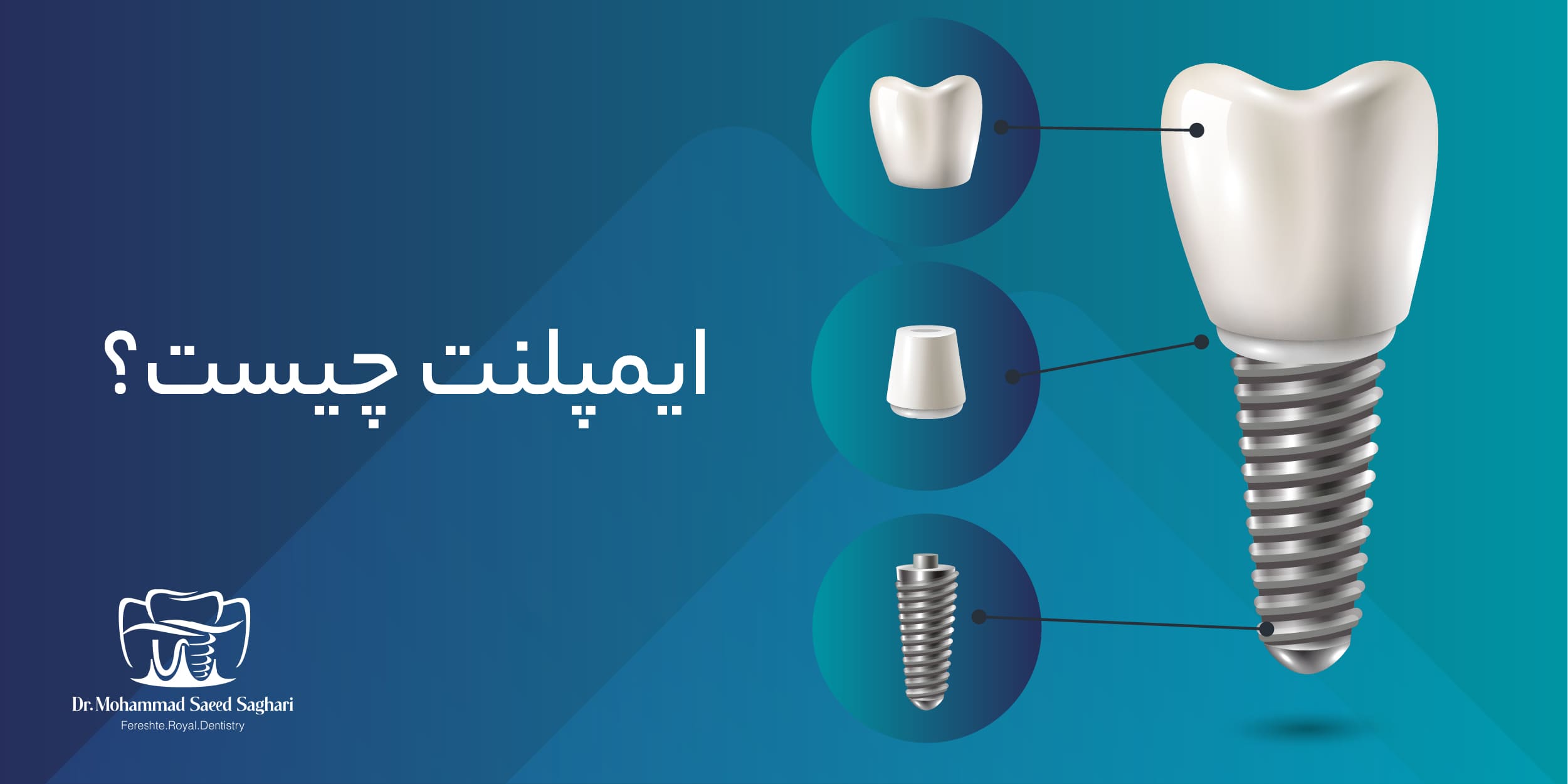 دکترمحمدسعیدساغری ایمپلنتولوژيست دندانپزشک جراح دندانپزشک drsagharidds mohammadsaiedsaghari drsagharid dentist