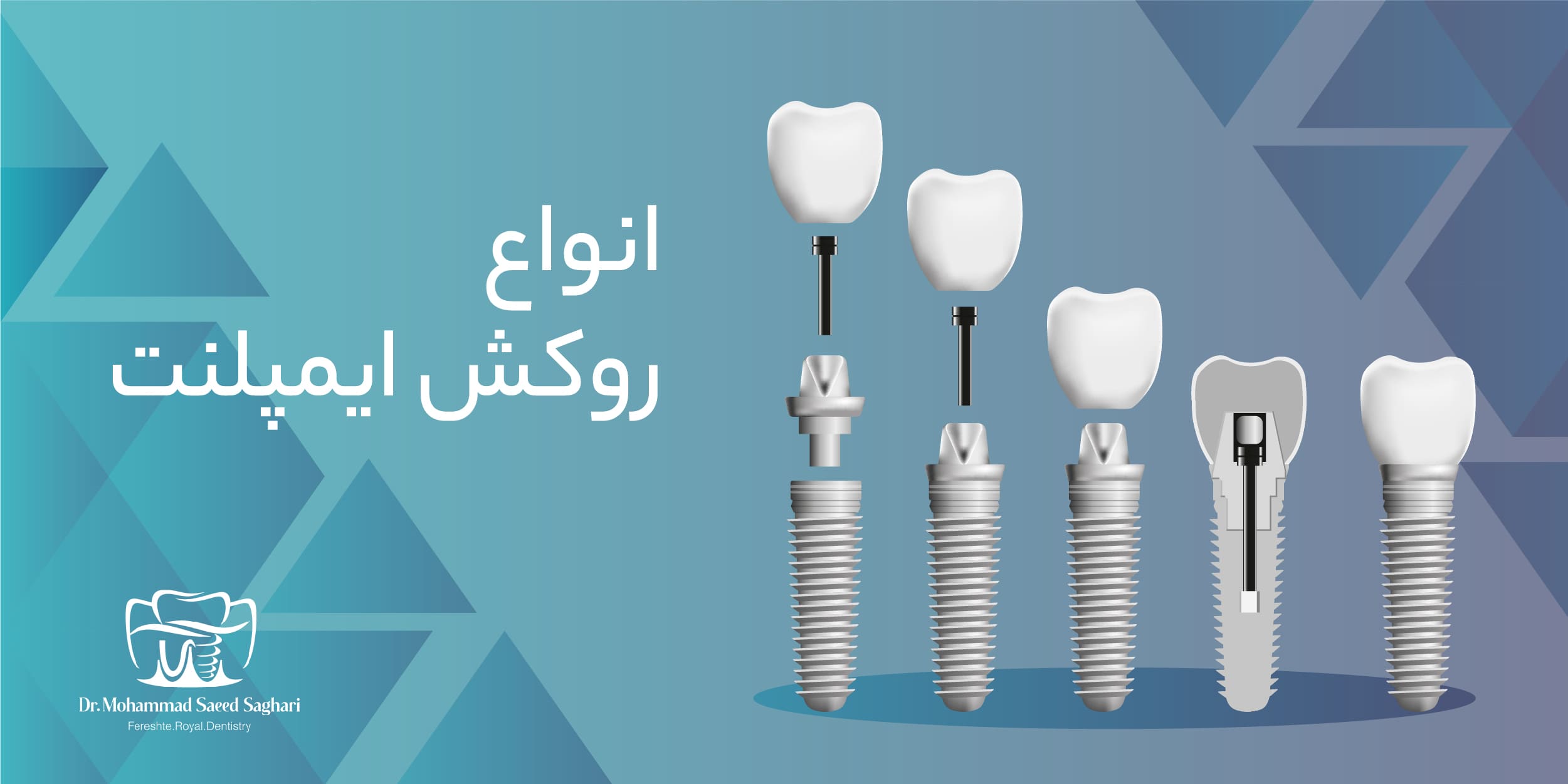 دکترمحمدسعیدساغری ایمپلنتولوژيست دندانپزشک جراح دندانپزشک drsagharidds mohammadsaiedsaghari drsagharid dentist