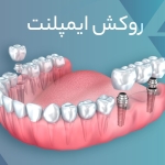 دکترمحمدسعیدساغری ایمپلنتولوژيست دندانپزشک جراح دندانپزشک drsagharidds mohammadsaiedsaghari drsagharid dentist