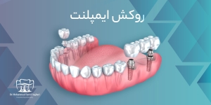 دکترمحمدسعیدساغری ایمپلنتولوژيست دندانپزشک جراح دندانپزشک drsagharidds mohammadsaiedsaghari drsagharid dentist