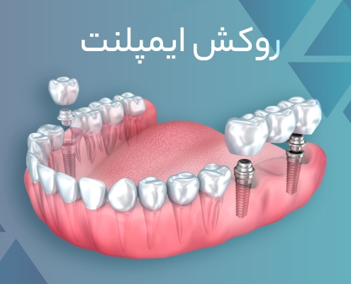 دکترمحمدسعیدساغری ایمپلنتولوژيست دندانپزشک جراح دندانپزشک drsagharidds mohammadsaiedsaghari drsagharid dentist